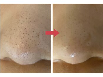 オレンジ(Orange)/【顔全体】毛穴・角質ケア120分