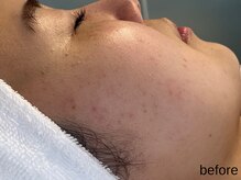 サロン ド エメ(salon de aimer)/【Before】シミもお任せください