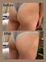 アムール 麻布十番(Amour)/エンダモロジーヒップアップケア