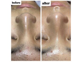 ミミ(mimi)/毛穴洗浄&無針水光注入