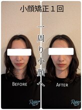 リバイブ 自由が丘店(REVIVE)/小顔矯正+ドライヘッドスパ1回