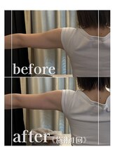 アムール 麻布十番(Amour)/エンダモロジー1回効果(二の腕)