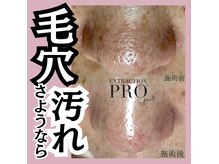 黒ずみや角栓の汚れを取るだけでツルツル肌に！