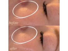 シュカ(Shuka)/ハーブピーリング