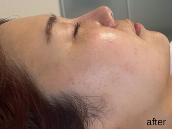 サロン ド エメ(salon de aimer)/【After】シミ分解!透明感!