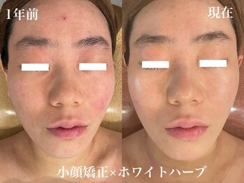 オレアグリーン 岡崎(OLEA green)/1年の変化(小顔ハーブ/毛穴)