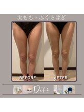 デフィ(Defi)/脚/ふともも/ビフォーアフター