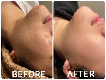 ハーブピーリング 心斎橋/ ハーブピーリングでニキビケア