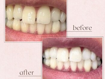 ルアナシンフォニア エクシア 恵比寿店(Luana-Sinfonia)/ホワイトニングビフォーアフター