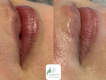 メゾンビューティーポピンズ 恵比寿(maisonbeauty poppins)/毛穴洗浄　マツヤニワックス脱毛