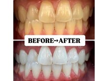 ホワイトニングサロン 豊中/Before&After美白ホワイトニング