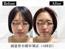 ポーベルポー(Peau Belle poe)/頭蓋骨小顔W矯正＋選べるパック