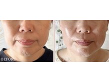 ロジワール(LOISIR)/フェイスラインの印象変化