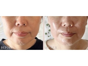 ロジワール(LOISIR)/フェイスラインの印象変化