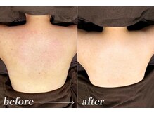ハルミハーブピーリング 池袋店(Harumi Herb Peeling)/背中見せに自信！