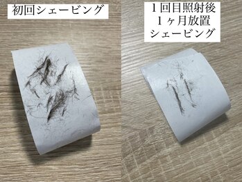 テンパ ビューティー(+10%beauty)/顔のムダ毛