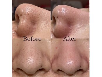 毛穴専科/毛穴洗浄+白玉ワックス メンズ◎