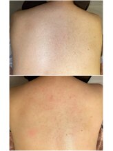 エースタイル(A-style.)/背中☆シュガーリング脱毛