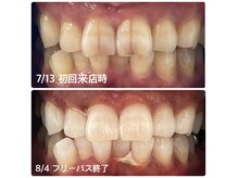 ホワイトニングショップ 盛岡店(WHITENINGSHOP)の雰囲気（お客様ビフォーアフター♪汚れがしっかり落ちました！）