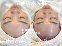 回数を重ねれば重ねるほど憧れの透明感あふれる天使の水光肌に♪