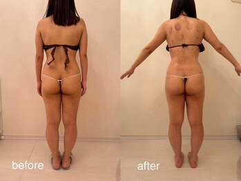 クロレ 浦和店(CLORE)/20代のお客様/18回施術