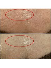 ラメール(La_mer)/【ララピール】before/after