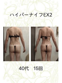 ベルシア 吉祥寺店(BELCIA)/ハイパーナイフEX2/ダイエット