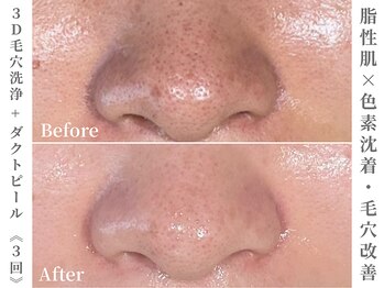 ゼアー(THERE FY.)/あなたの毛穴は何タイプ?