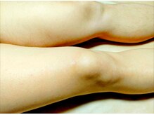 イニティウム 清澄白河(initium)/【男性脚WAXムダ毛オフ施術例】