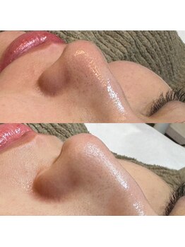 トム(Thom)/毛穴汚れごっそりメニューはコレ