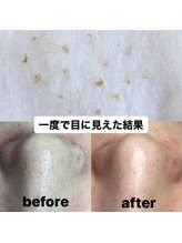 ビューティーネイル(Beauty Nail)/毛穴エクストラクション