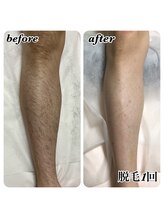 パーソナルエステティックサロン リボーン(ReBorn)/メンズ脱毛◎腕/脚/お腹も人気!