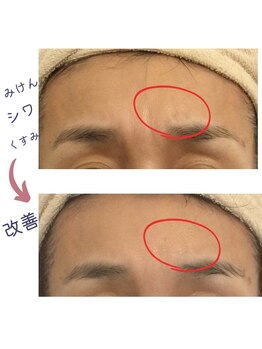 シーフェイス(see face)/眉間の深いシワも改善