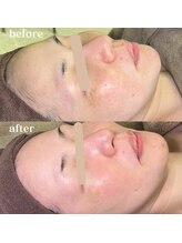 ソルニコン(Solnikon)/陶肌トリートメントでくすみオフ