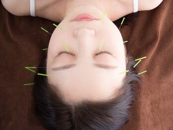 リラ 円山(lila)の写真/《リピーター続出》肌質&睡眠の質が格段にUP☆疲れて凝り固まった頭・首肩こりには美容鍼がおすすめ◎¥8800