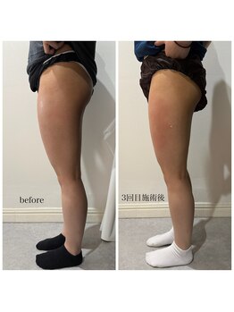 テンディ(TenD.)/太ももスッキリ