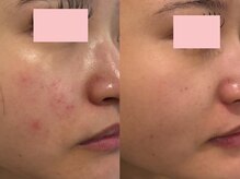 フレイヤビューティー スハダラボ 恵比寿(Freyia Beauty Suhada LABO)/ハーブピーリング