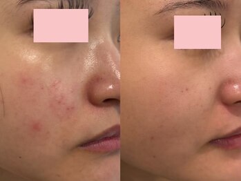 フレイヤビューティー スハダラボ 恵比寿(Freyia Beauty Suhada LABO)/ハーブピーリング