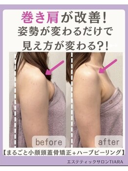 ティアラ(TIARA)/まるごと小顔矯正 1回の効果