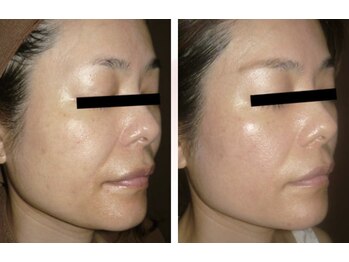 ジョアン(Johan)/大人気☆肌たるみを根本から改善