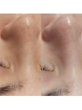 マイフェアレディ 今池(MyFairLady)/毛穴洗浄★ハイドロフェイシャル