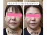  【たるみシワケア/次世代のリフトアップ】お顔と首から引き上げる　60.分