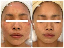 ナポデイズ(NAPODAYS)/長年の赤み・敏感肌のお悩み