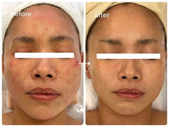 ナポデイズ(NAPODAYS)/長年の赤み・敏感肌のお悩み