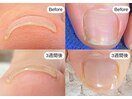 巻き爪ケア