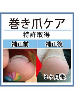 リフト 有楽町店(Re:ft)の写真/切らずに、巻き爪の痛みをその場でリセット。特許技術で叶える、巻き爪補正。
