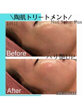 プア(Pua)/ハーブピーリング