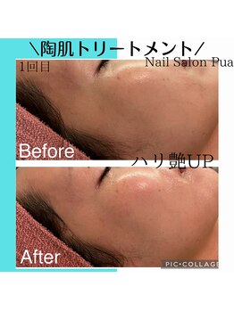 プア(Pua)/ハーブピーリング
