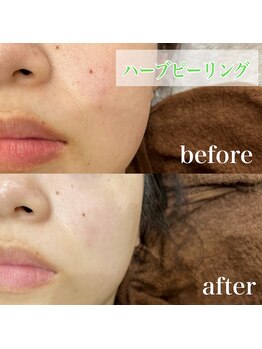 リラッシュ 駅南店(RELASH)/OHL【ハーブピーリング】