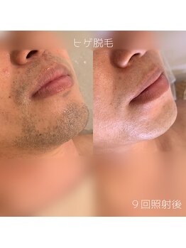 WA ネイル アンド ビューティー(WA nail & beauty)/ヒゲ脱毛